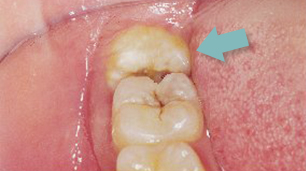 Decayed Wisdom Tooth