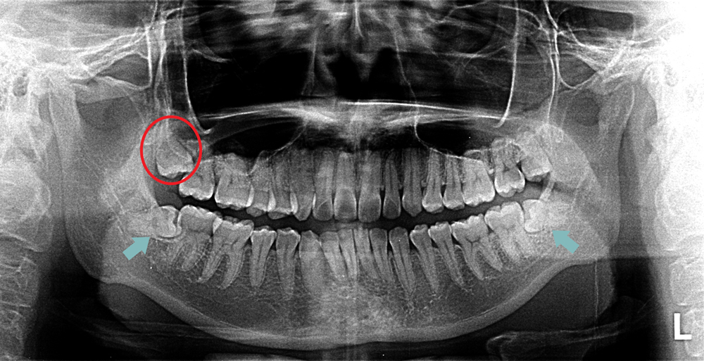 panoramic x-ray showing impacted wisdom teeth