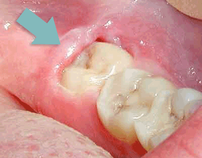 Partially-erupted Wisdom Tooth