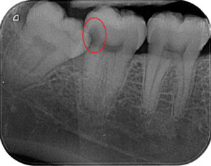 X-ray of decayed tooth caused by wisdom tooth