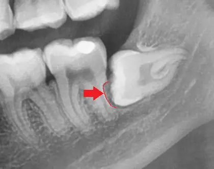 root resorption of second molar