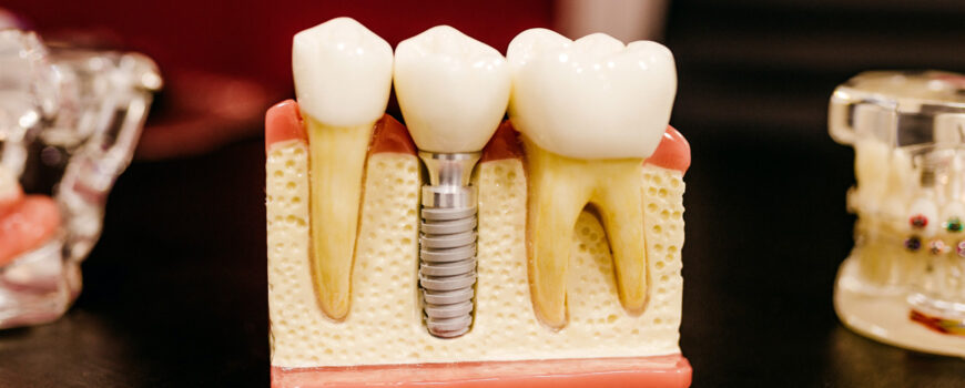 What Are Dental Implants and Am I Suitable for Them?