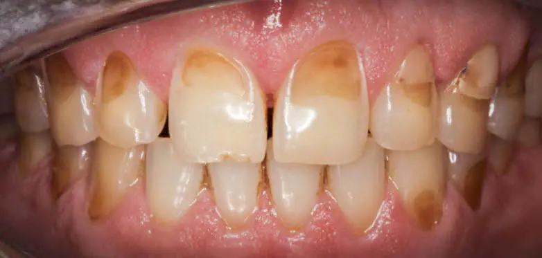 teeth with worn down enamel