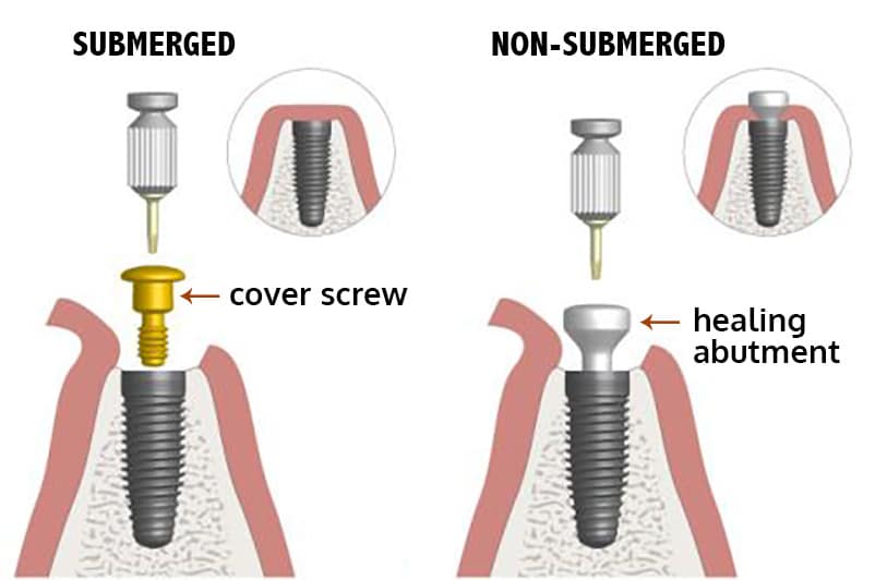 submerged vs non-submerged implants