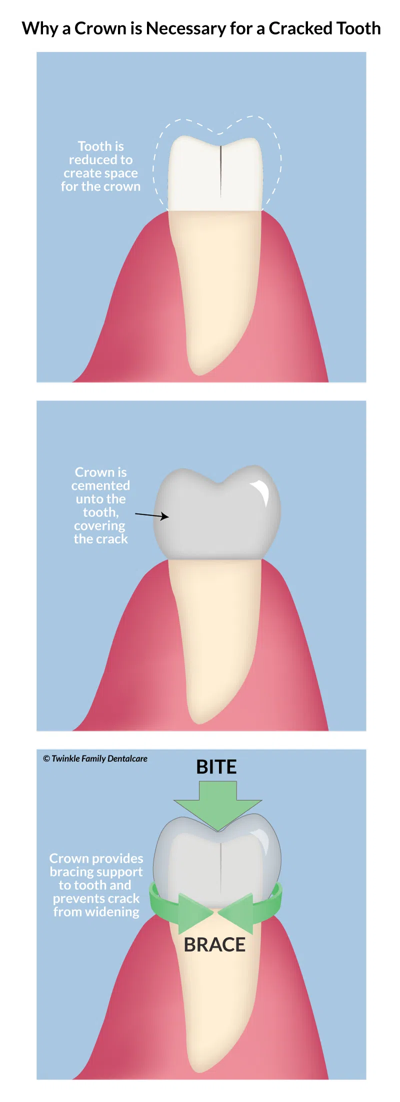 Why a crown is necessary for a cracked tooth, to provide bracing support