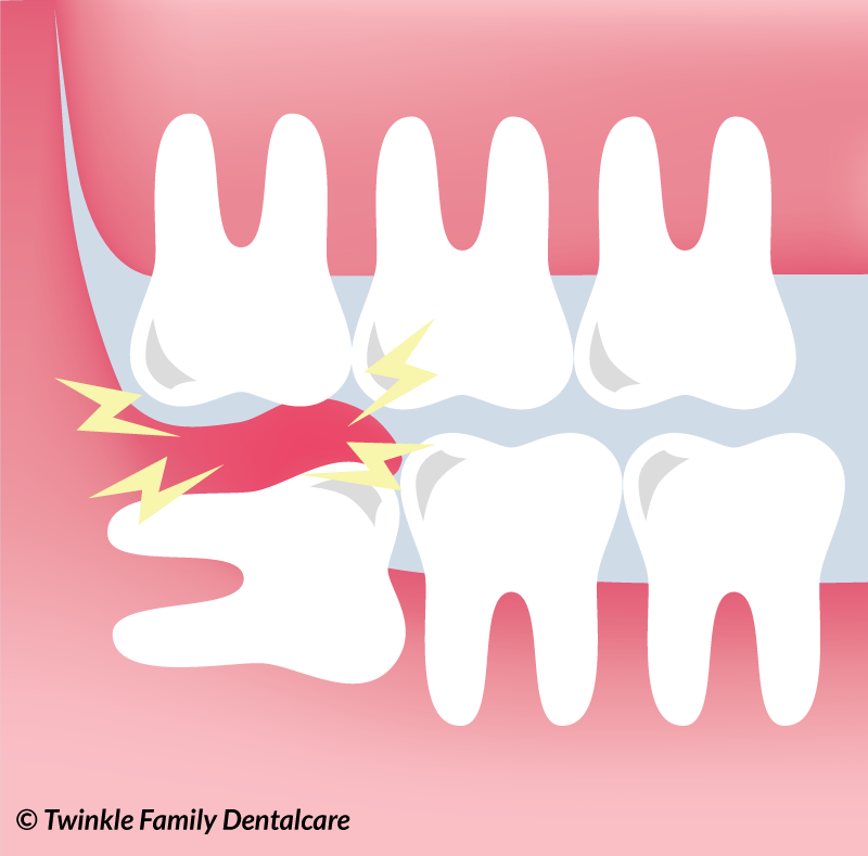 Image showing an upper wisdom tooth biting onto the swollen lower gums, causing pain