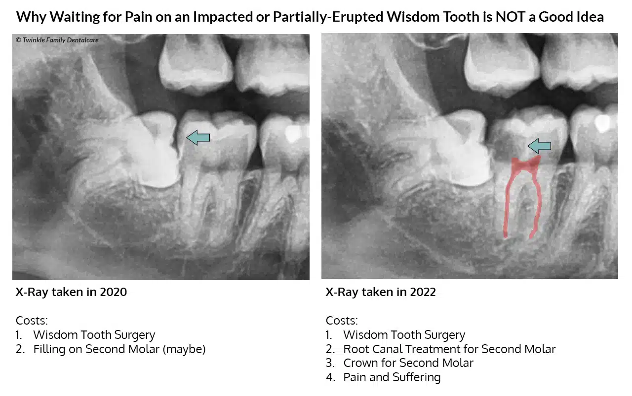 X-ray of impacted wisdom tooth taken 2 years apart showing decay progression into pulp of adjacent second molar
