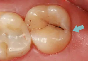Cracked Tooth Molar