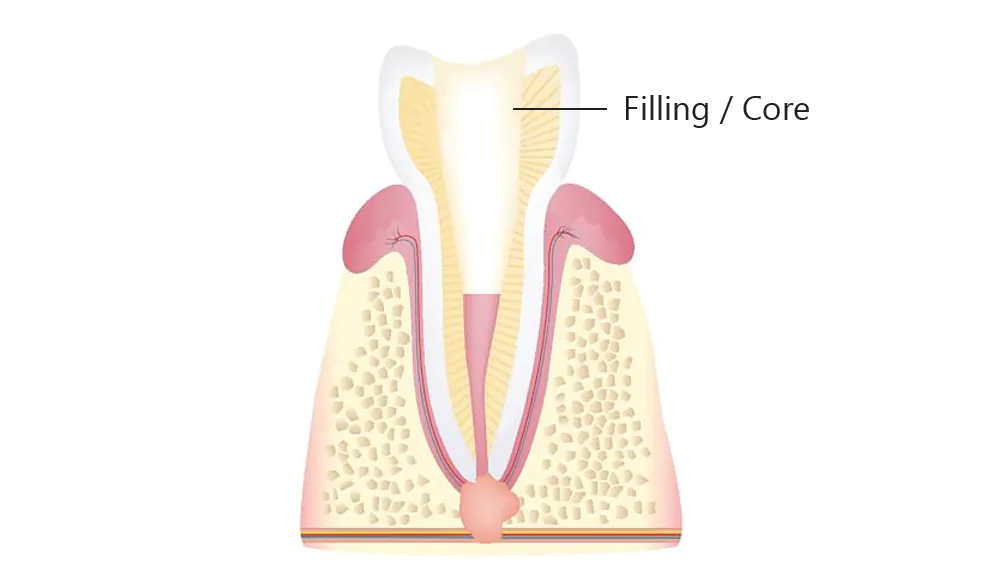 root canal with core