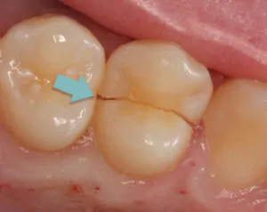 Split tooth