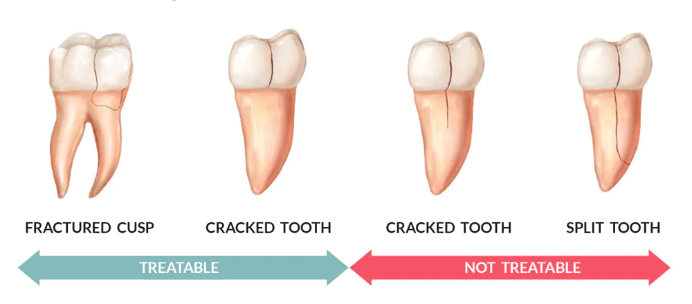Different Types of Cracked Tooth