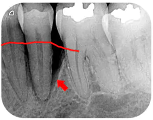 Tooth with bone loss
