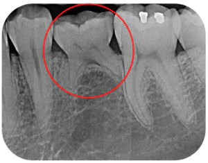 Retained Milk Tooth