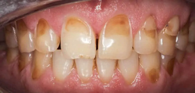 teeth with worn down enamel