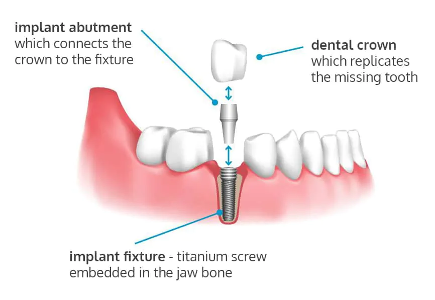 Implant with a Crown
