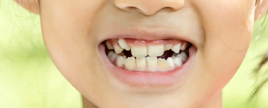Parents’ FAQ about Erupting Permanent Teeth (Part 1)