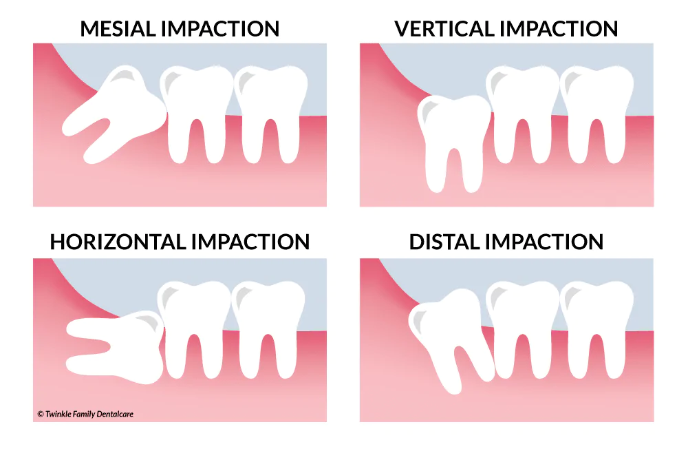 Types of Impaction