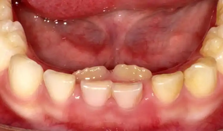 image showing lower permanent incisors erupting behind milk teeth