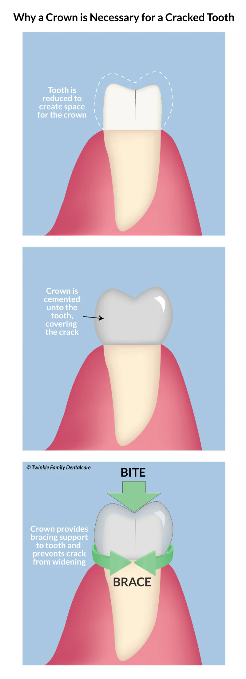 Why a crown is necessary for a cracked tooth, to provide bracing support
