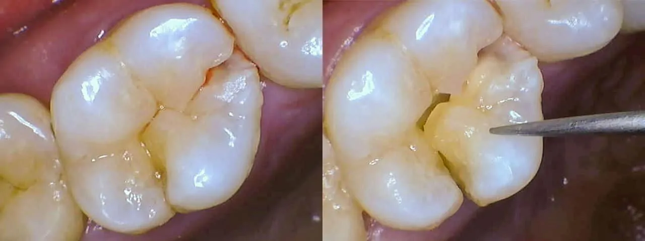 picture of a split tooth