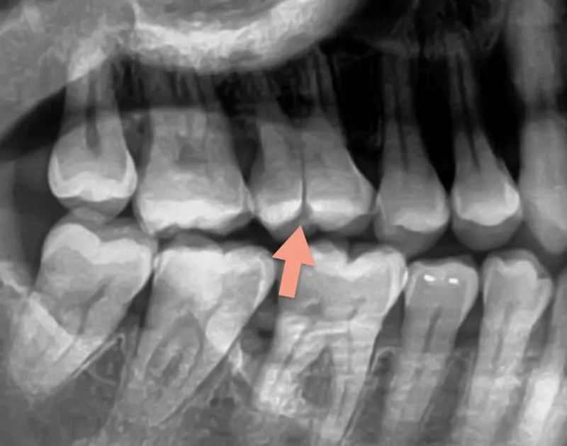 x-ray of a split tooth