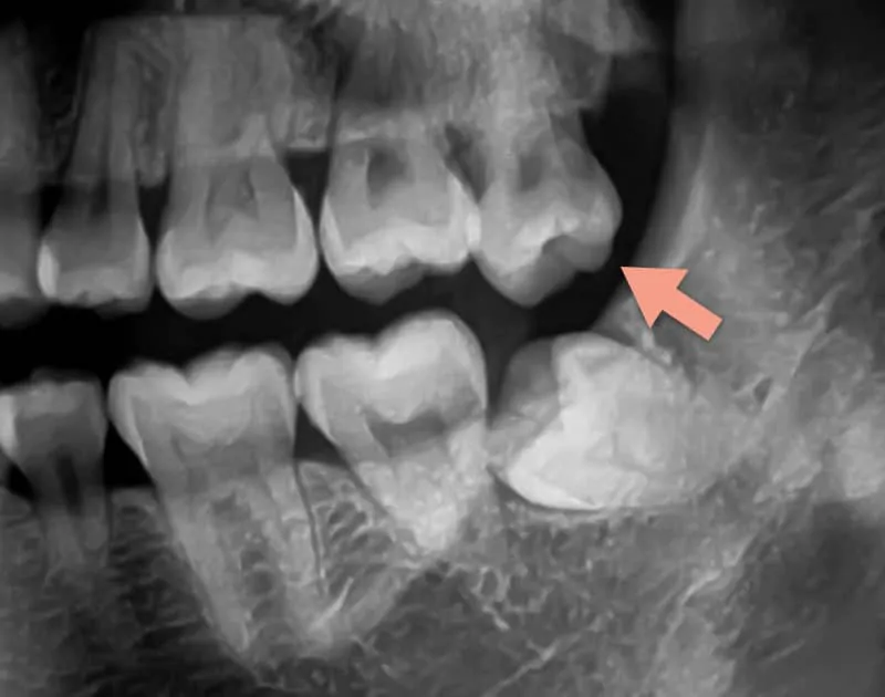 Xray image of over-erupted upper wisdom tooth