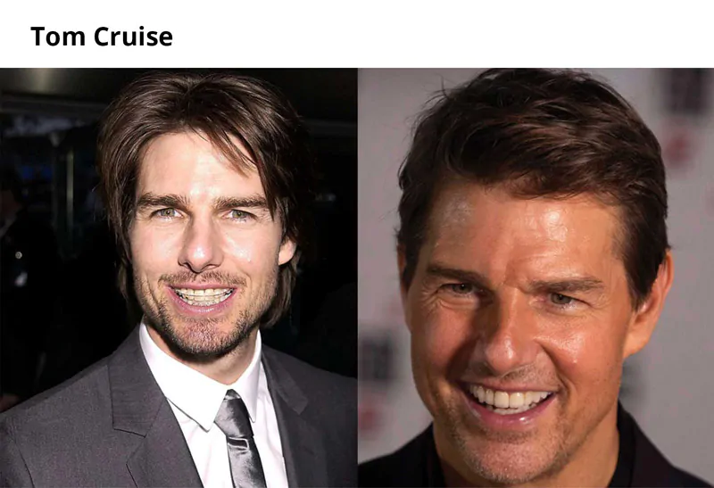 Tom Cruise with Braces