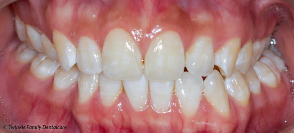 Photo of a Unilateral Crossbite
