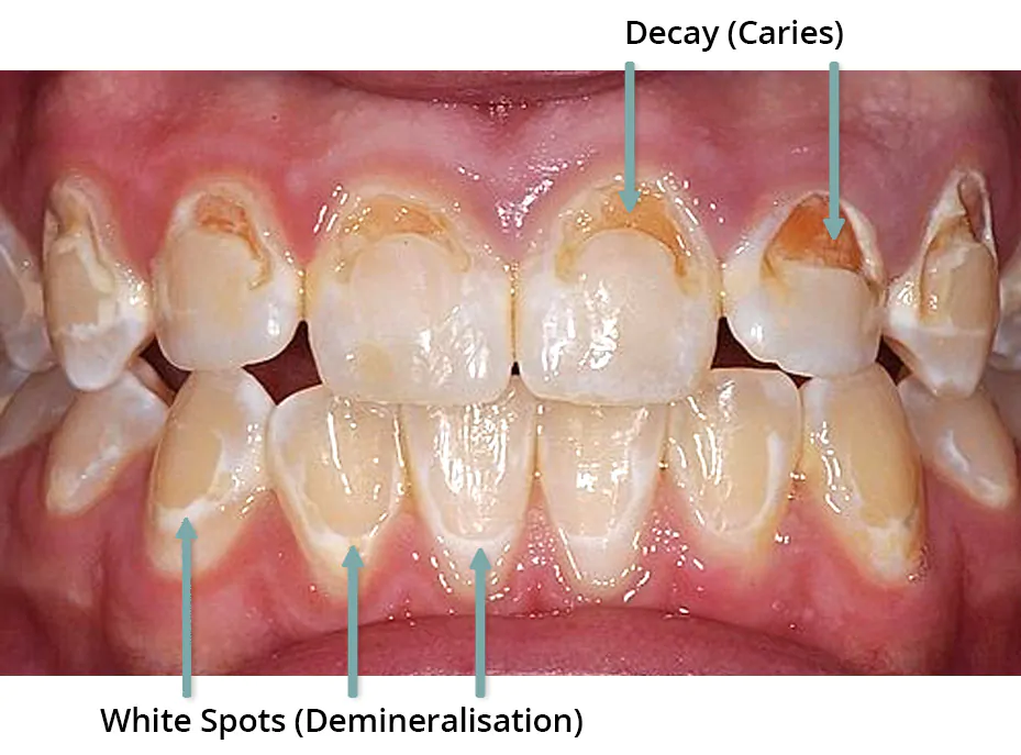 Decay caused by poor oral hygiene during braces
