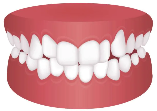 Crowded Teeth Illustration